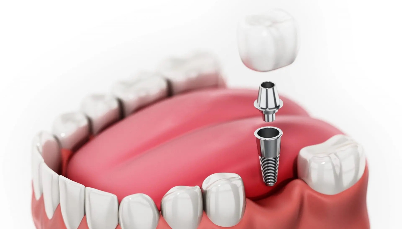 Odontoiatria conservativa